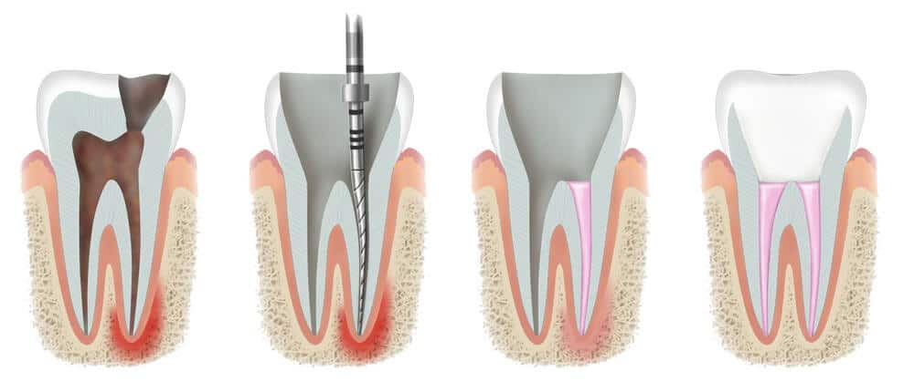Root Canal Treatment in Wilmington