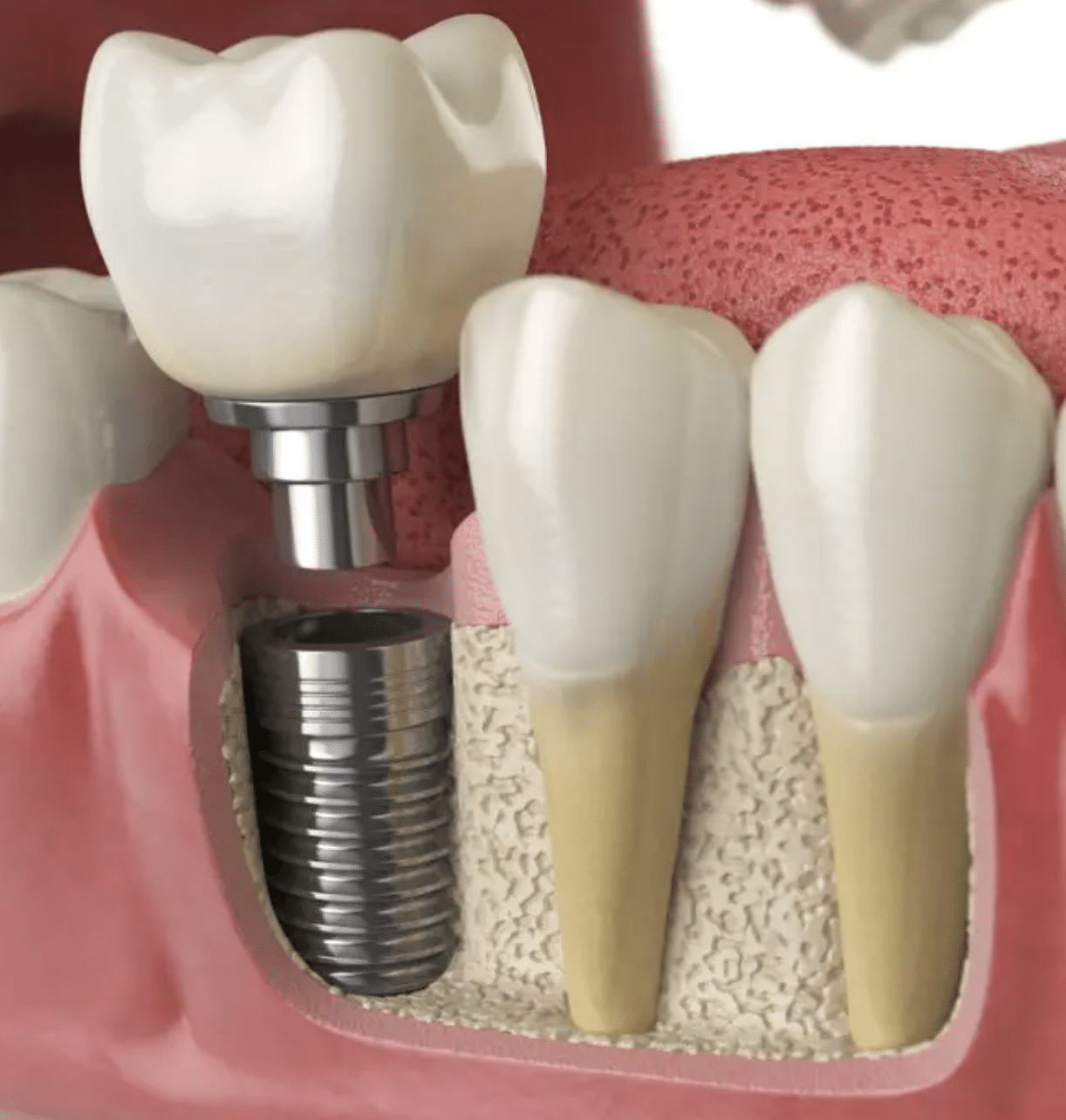 dental implant wilmington